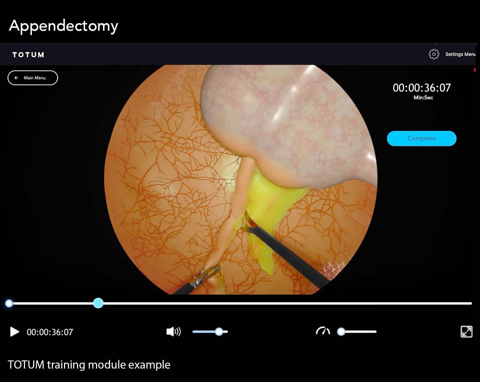 Appendectomy