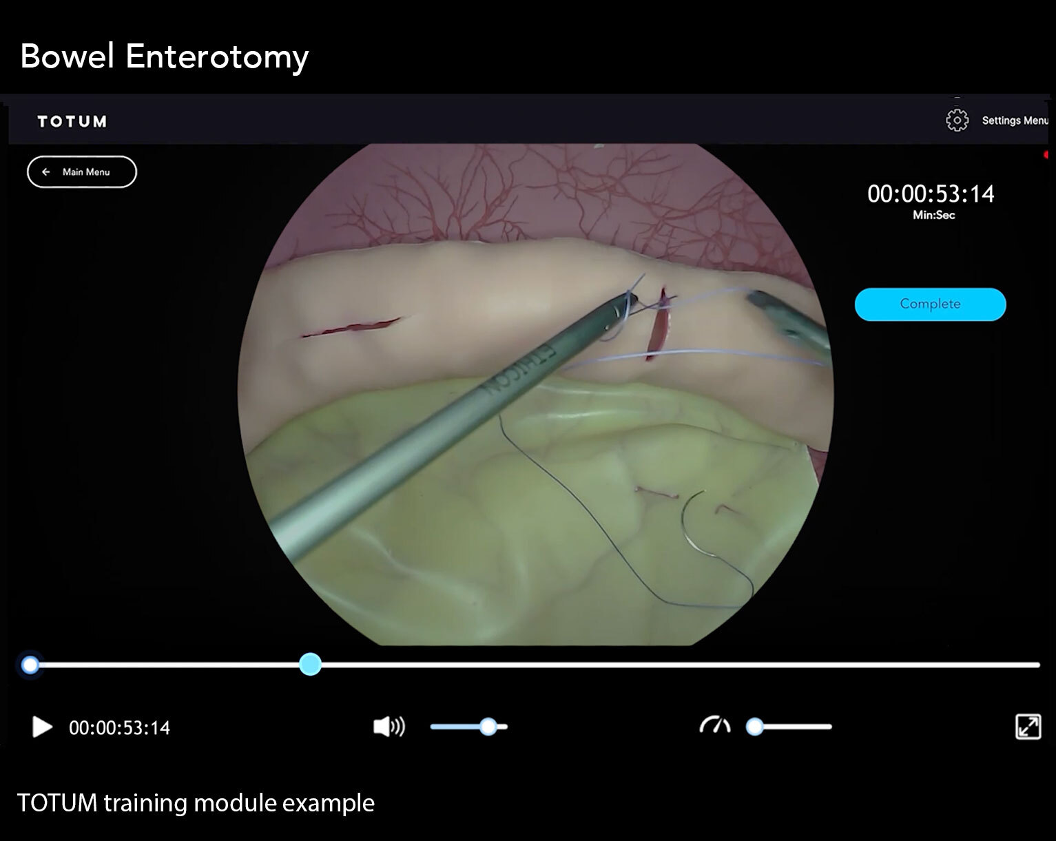 Bowel Enterotomy