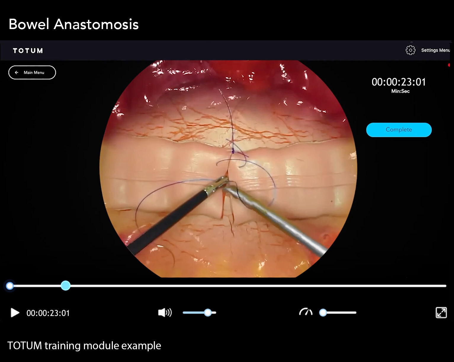 Bowel Anastomosis