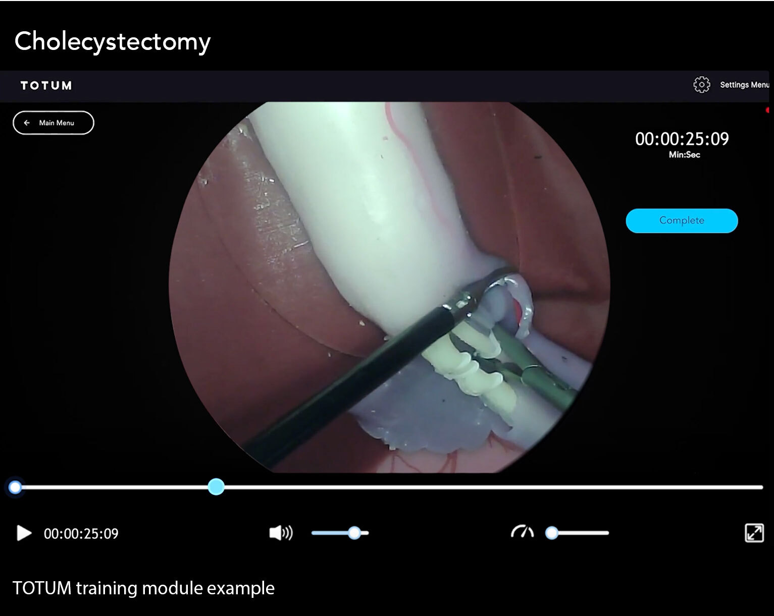 Cholecystectomy