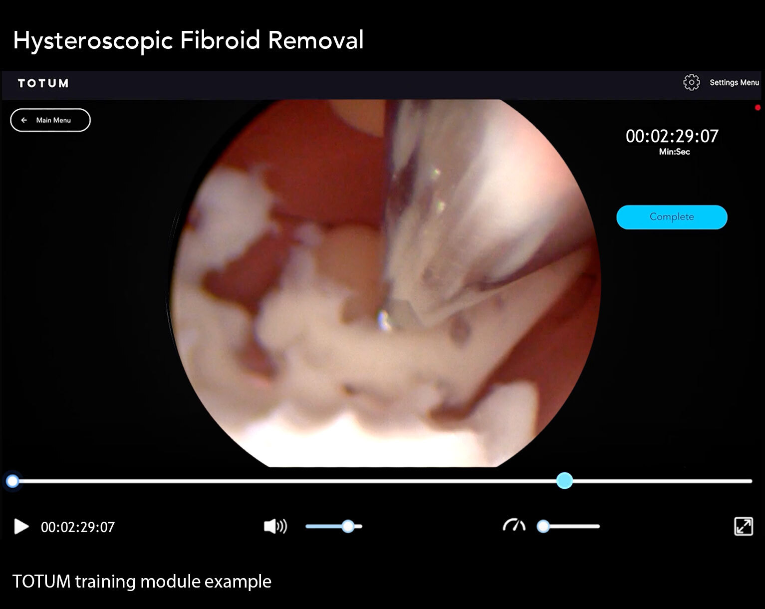 Hysteroscopic Fibroid Removal