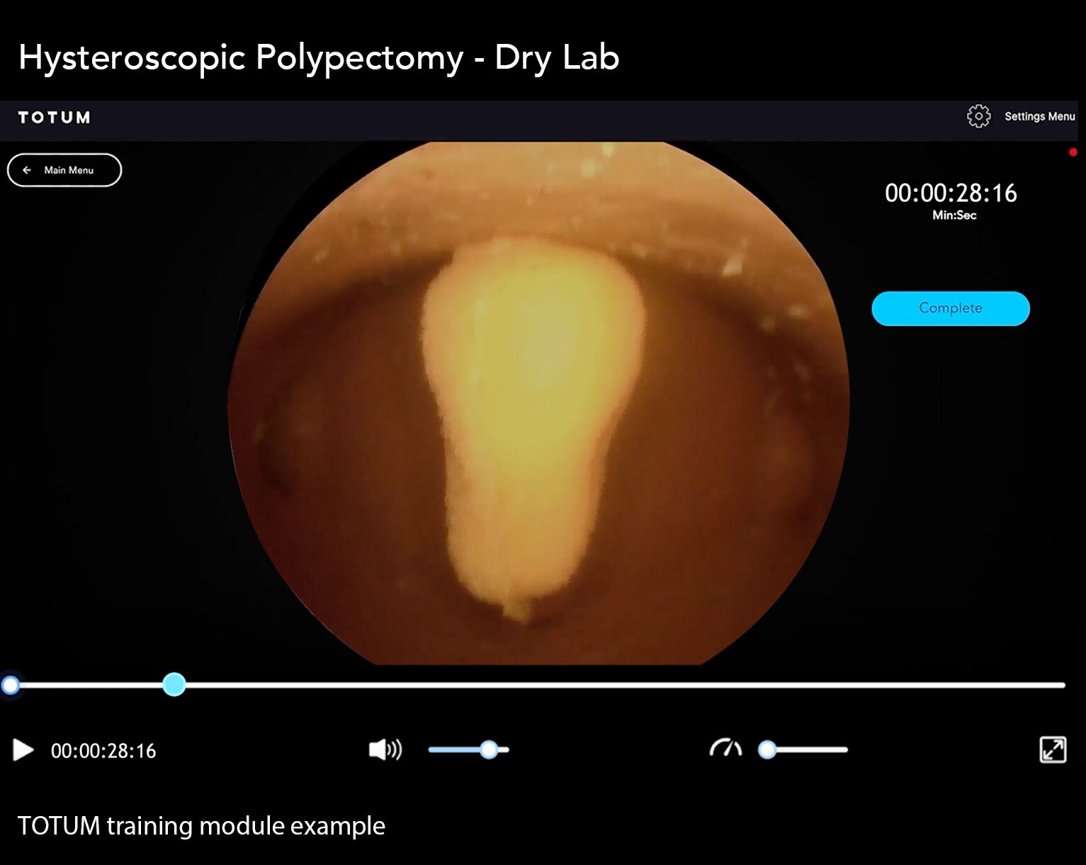Hysteroscopic Polypectomy - Dry Lab