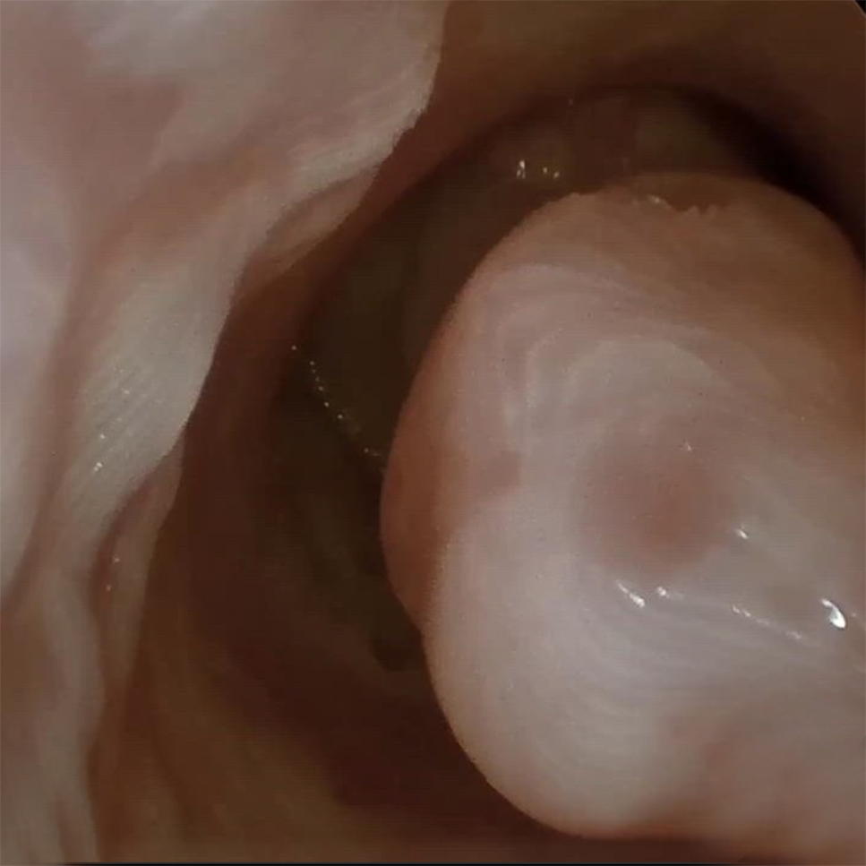 Hysteroscopic RPOC