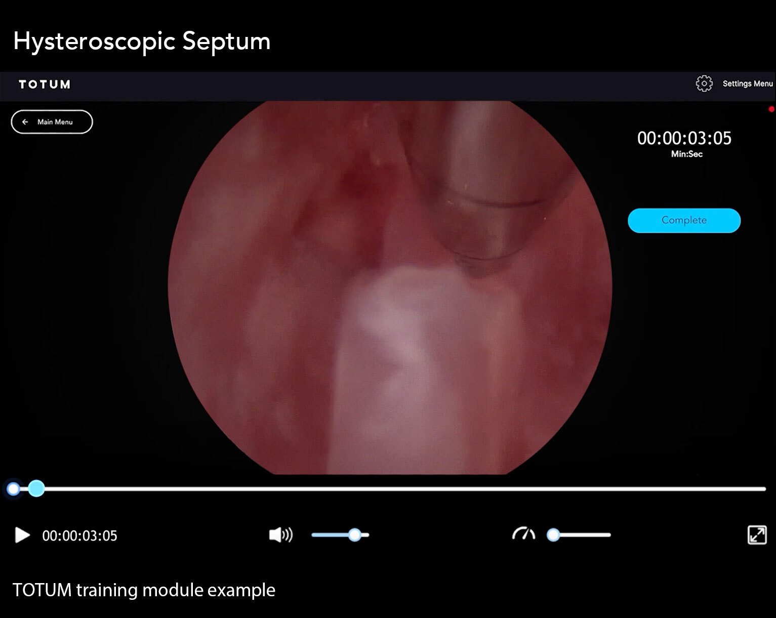 Hysteroscopic Septum
