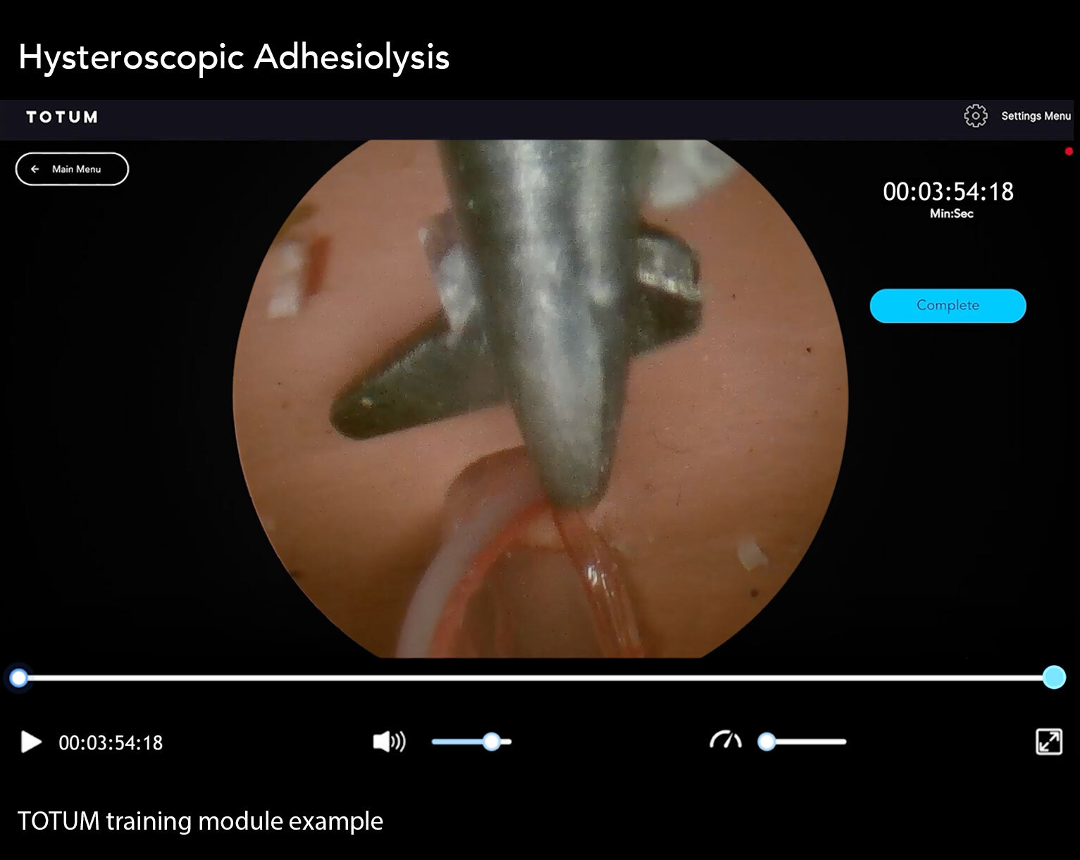 Hysteroscopic Adhesiolysis