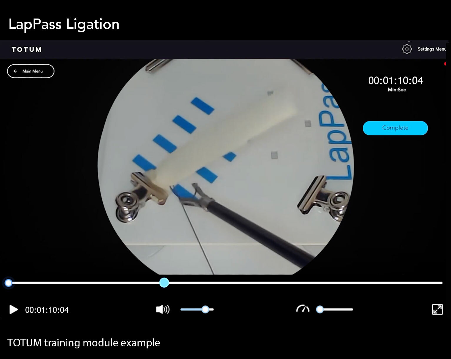 LapPass Tubal Ligation