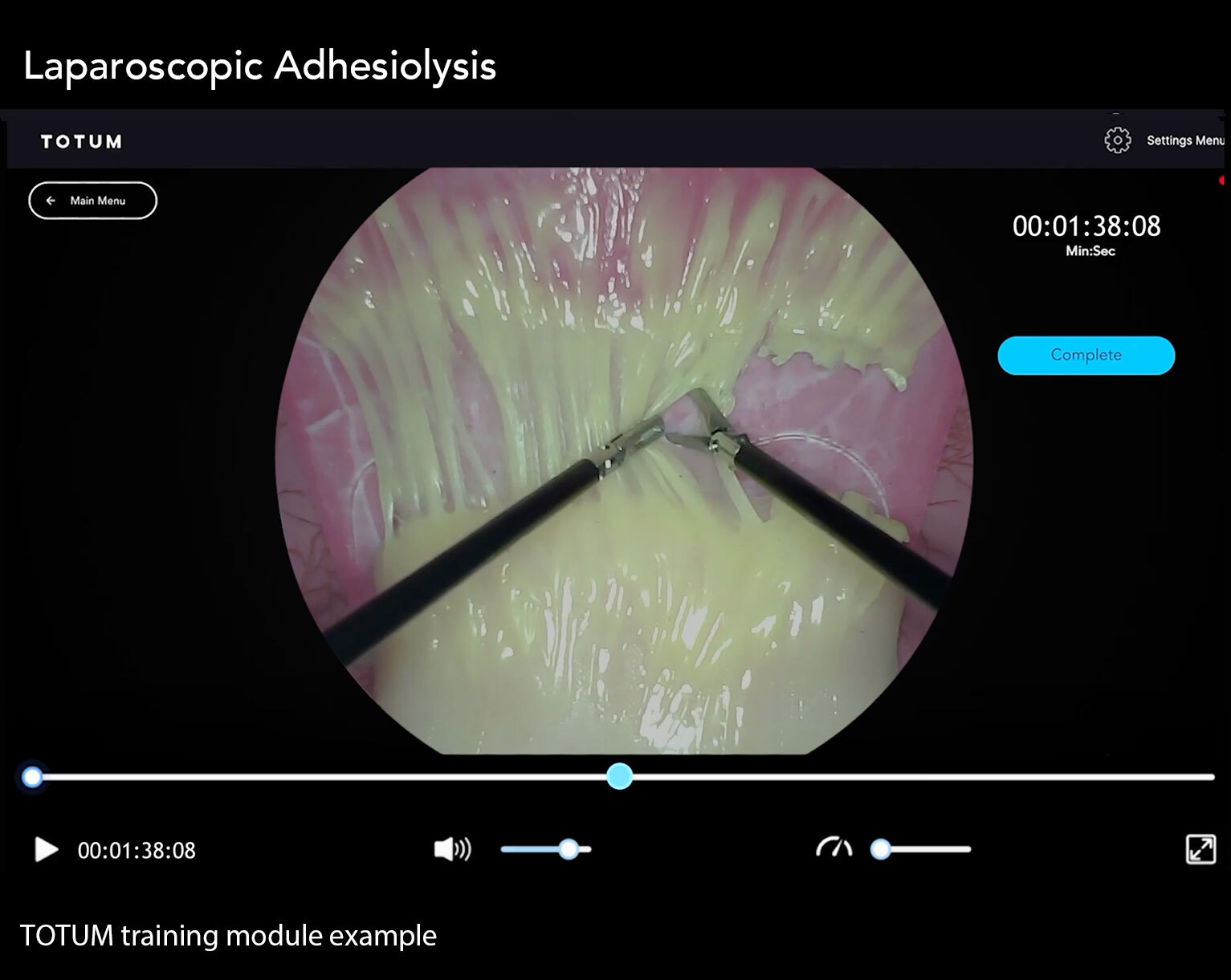 Adhesiolysis