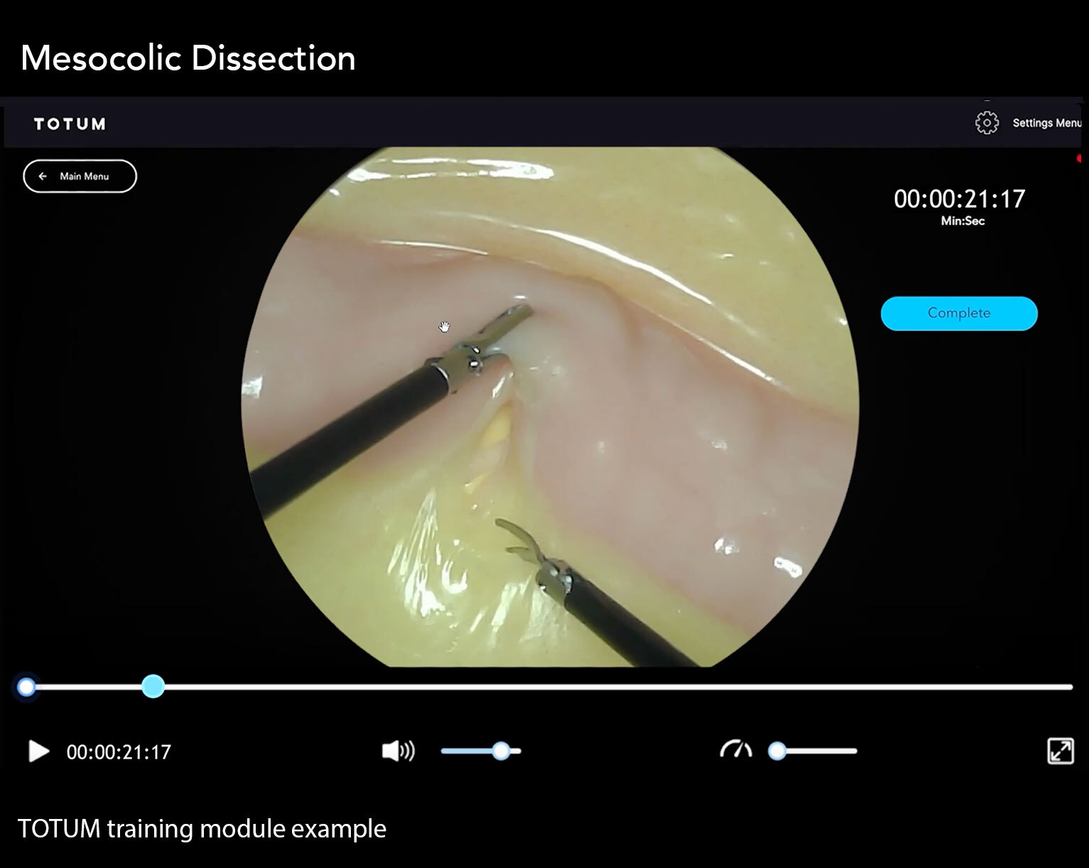 Mesocolic Dissection