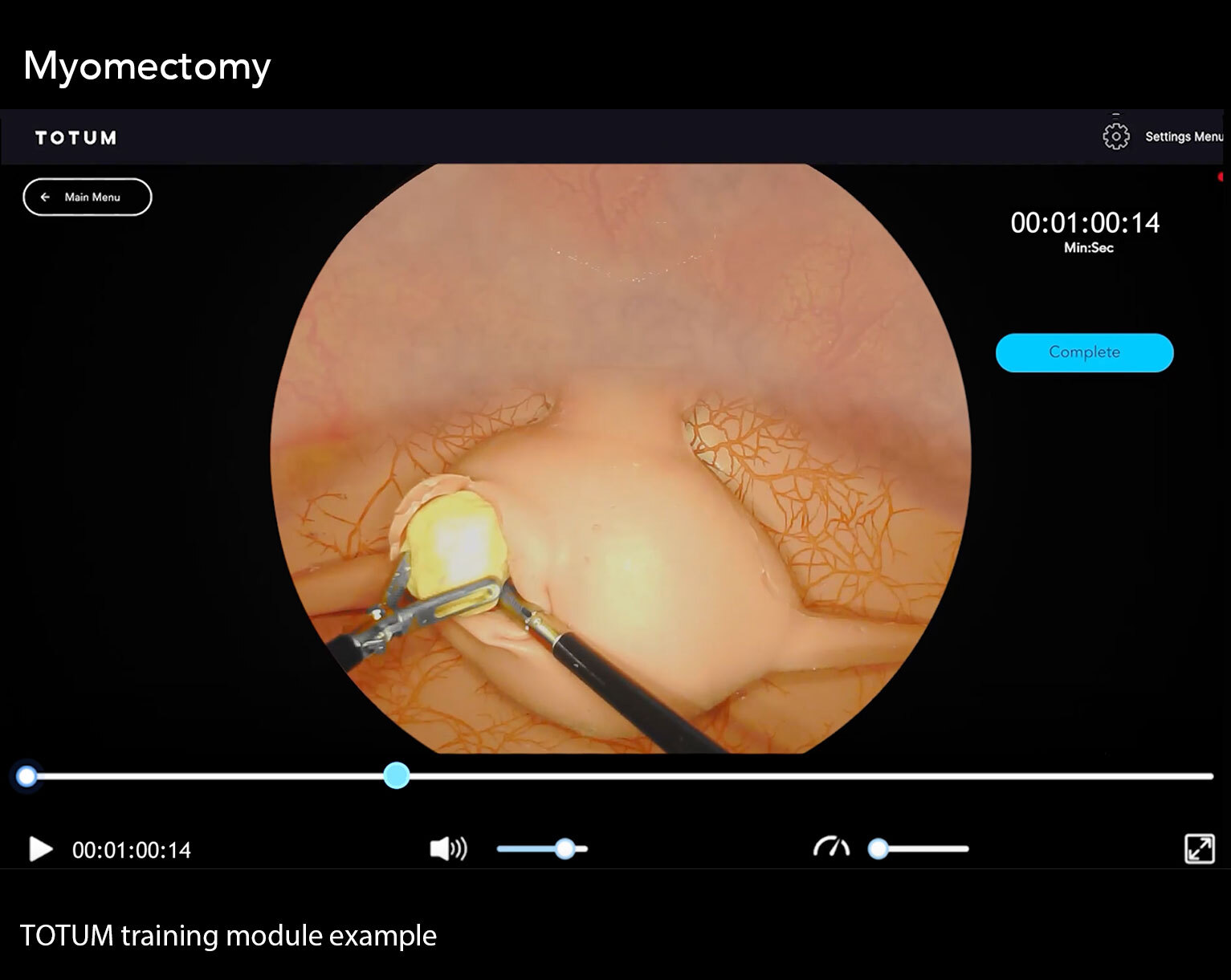 Laparoscopic Myomectomy