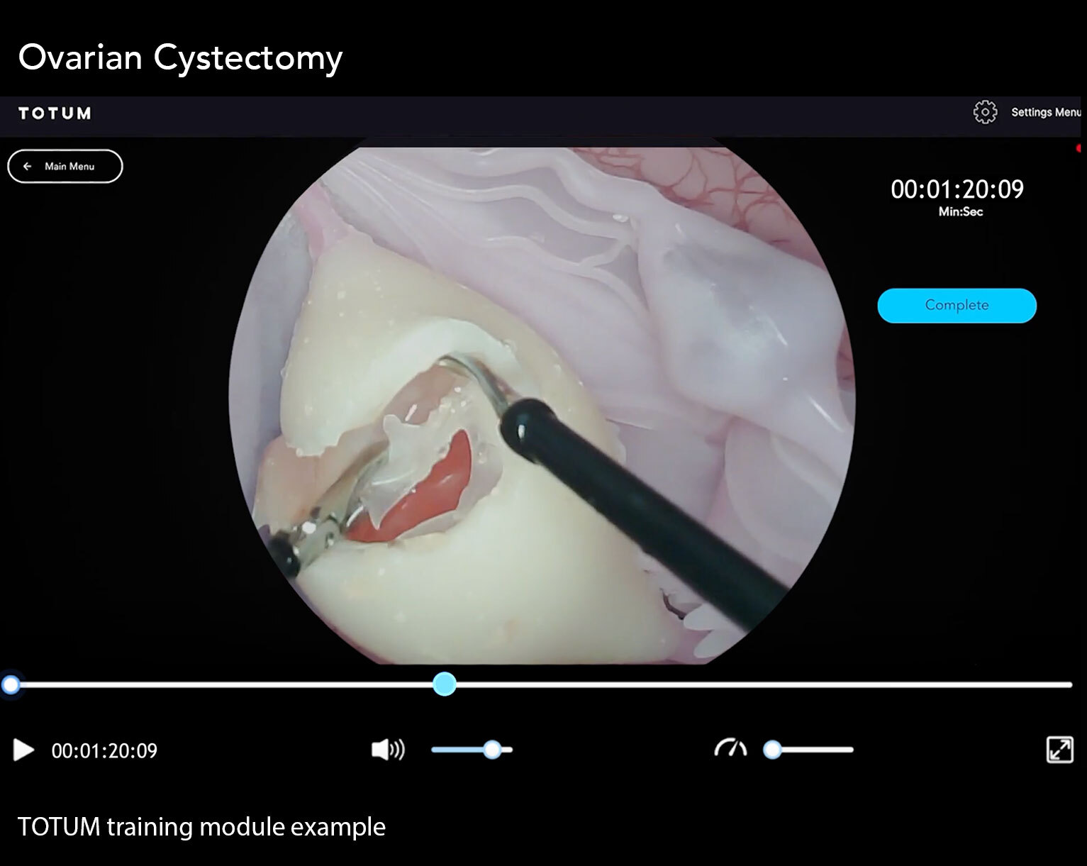 Ovarian Cystectomy
