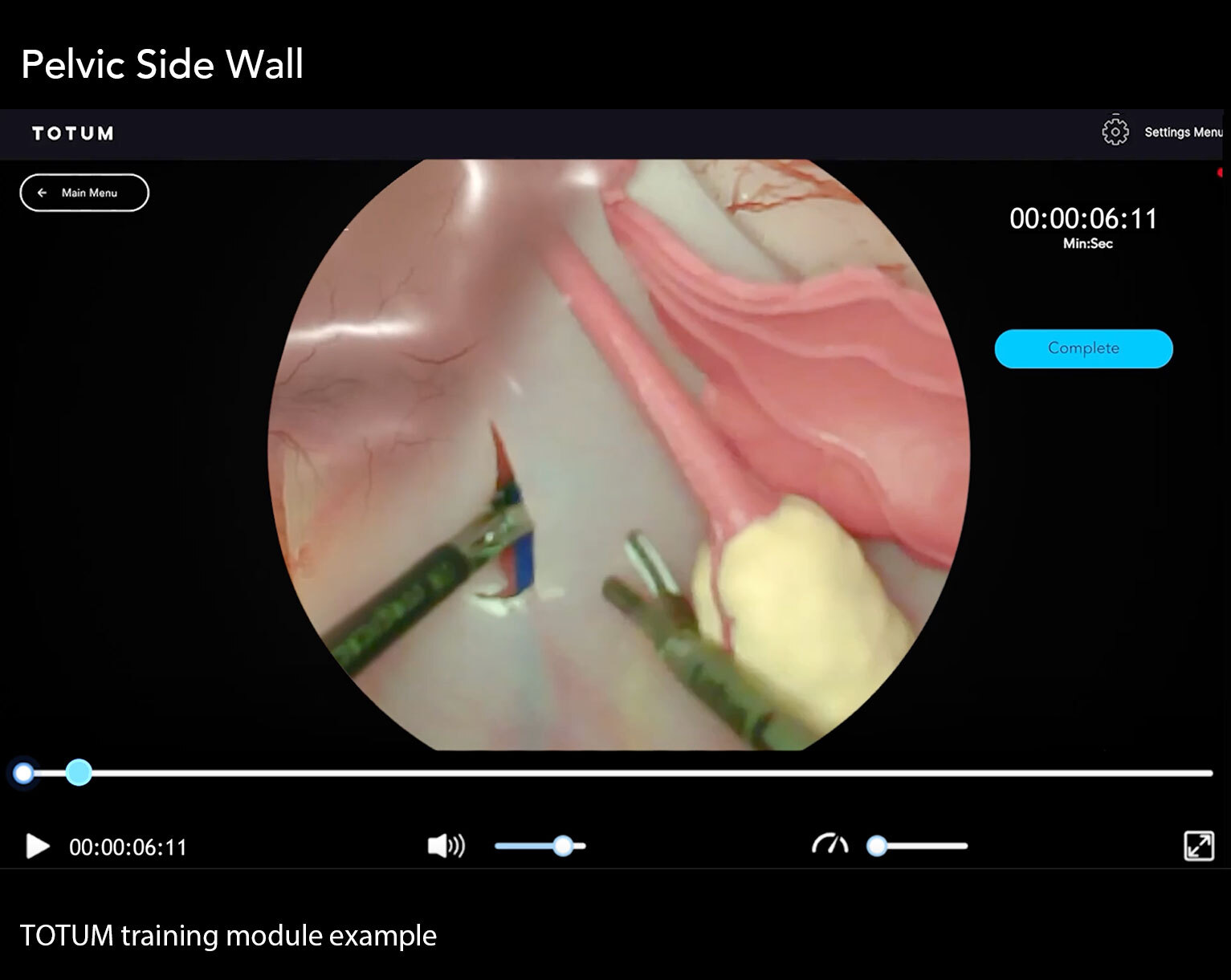 Pelvic Side Wall Dissection
