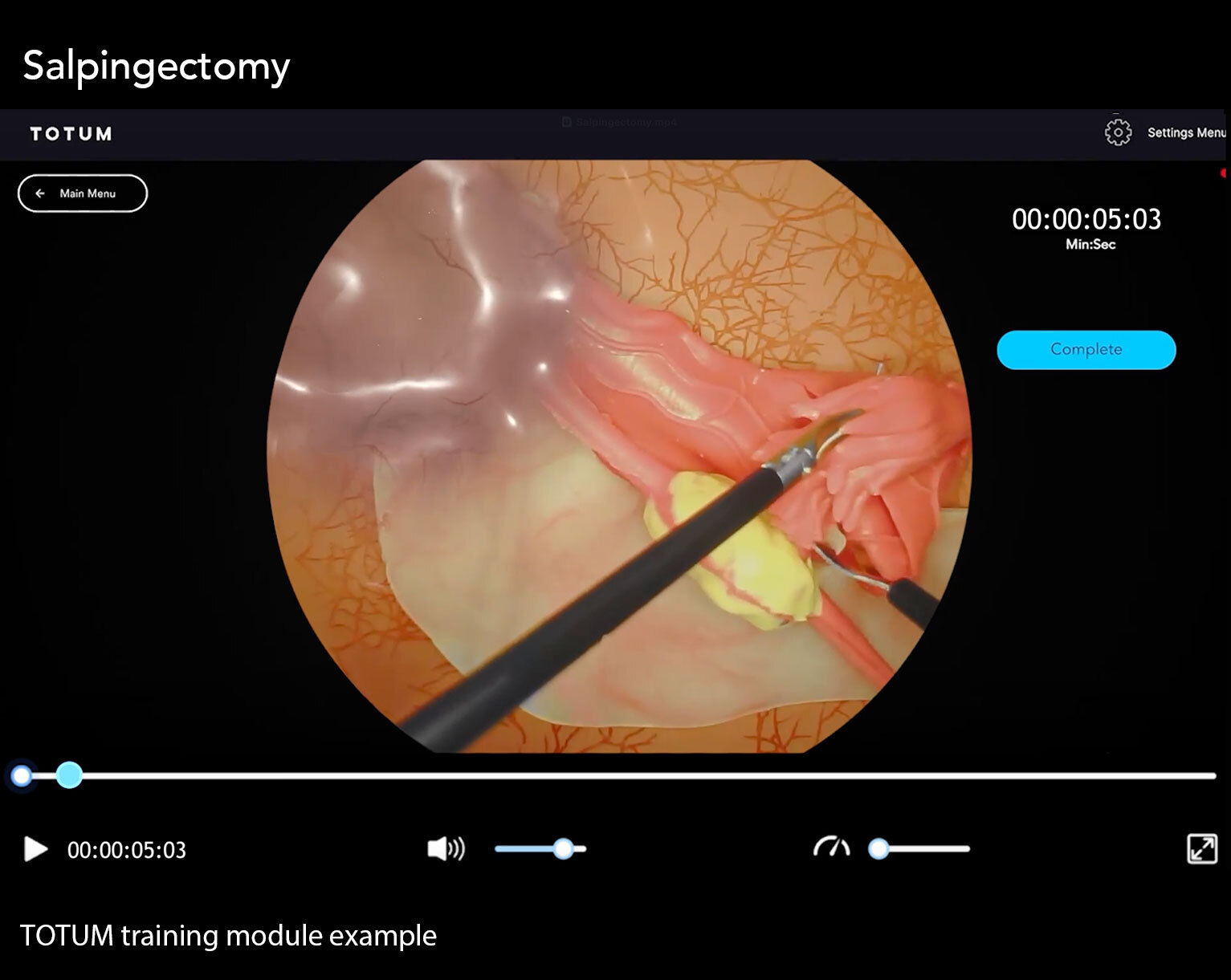 Salpingectomy