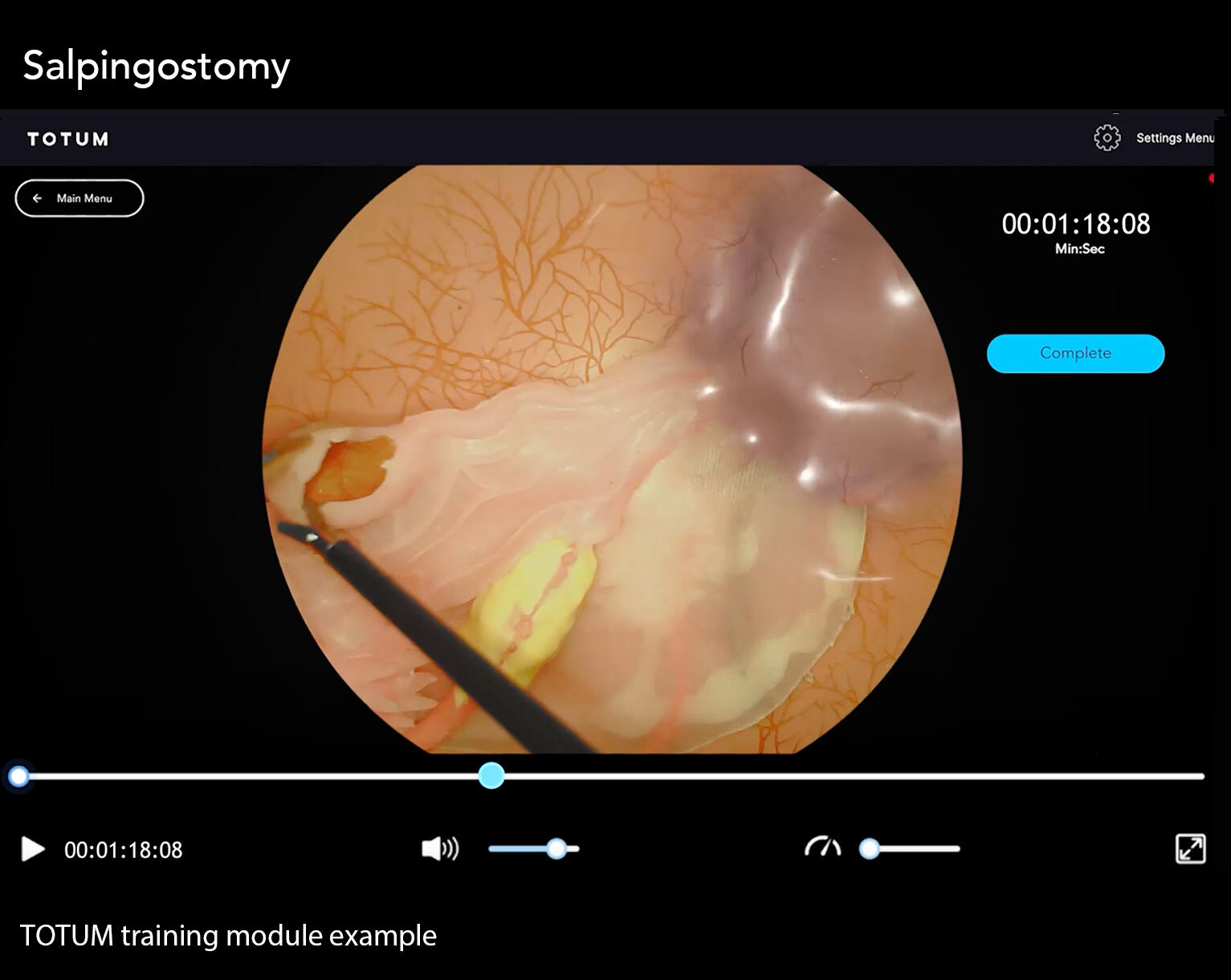 Salpingostomy