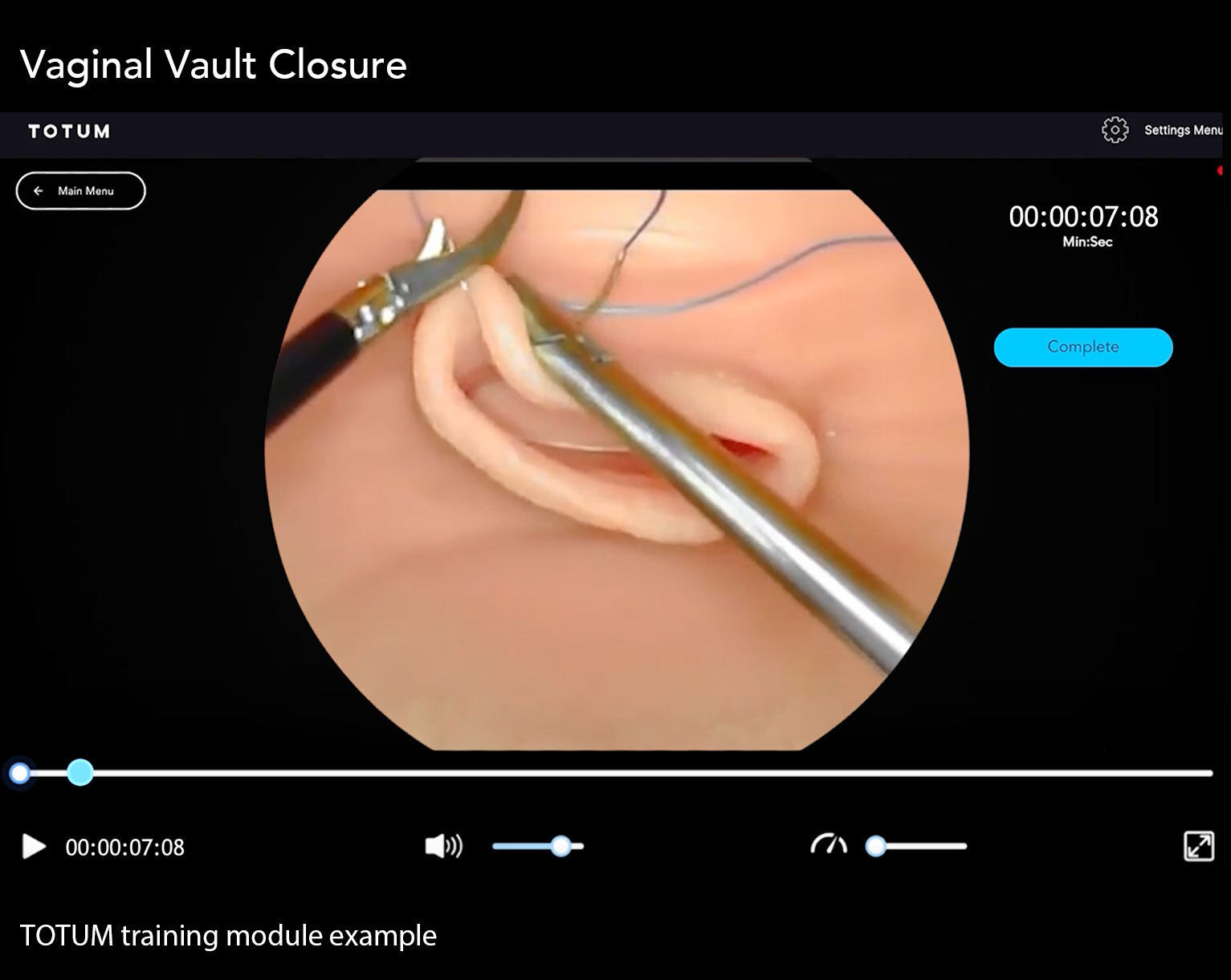 Vaginal Vault Closure